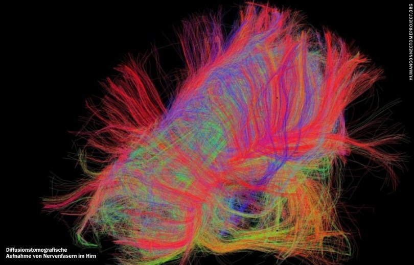 Diffusionsansicht Gehirn